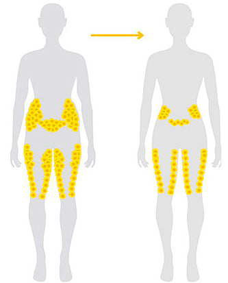 🔥Slimoly™ Matteo Ultrasonic Body Shape Wristband Pro 🔥